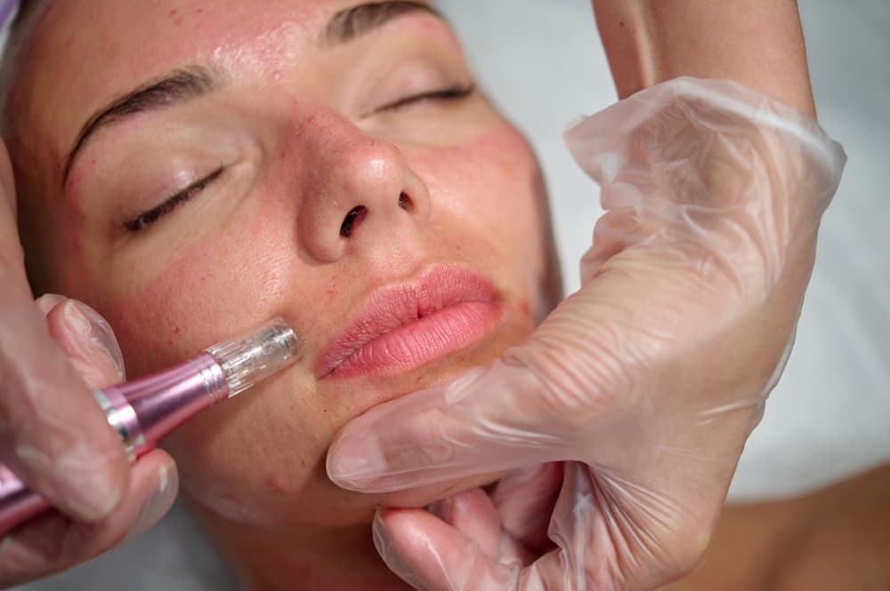 woman having microneedling done